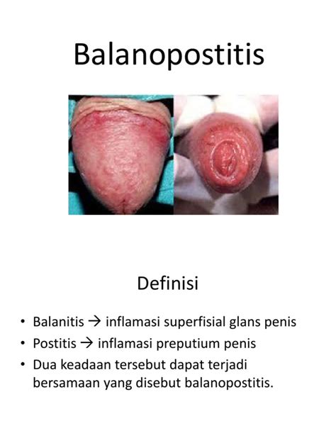 balanoposthitis reddit|pictures of balanoposthitis.